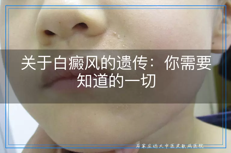 关于白癜风的遗传：你需要知道的一切