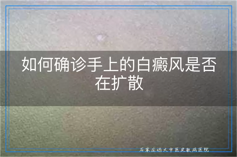 如何确诊手上的白癜风是否在扩散