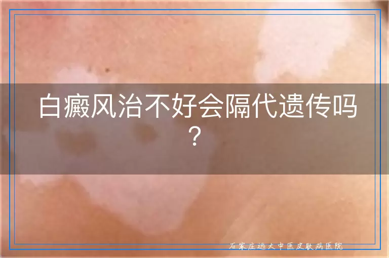 白癜风治不好会隔代遗传吗？