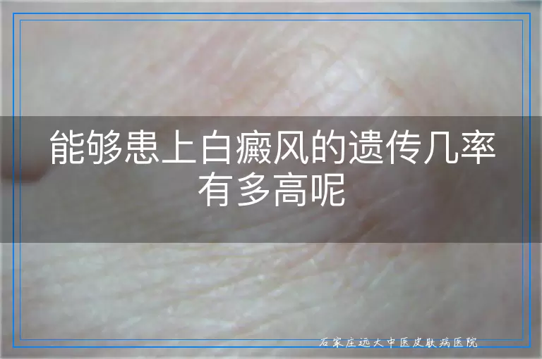能够患上白癜风的遗传几率有多高呢