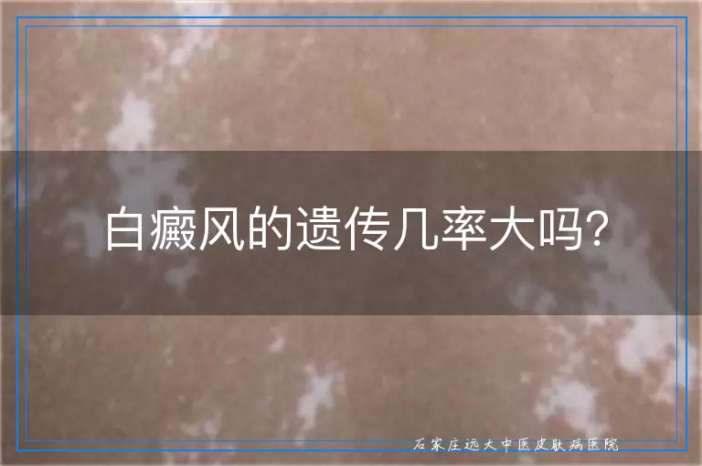 白癜风的遗传几率大吗？