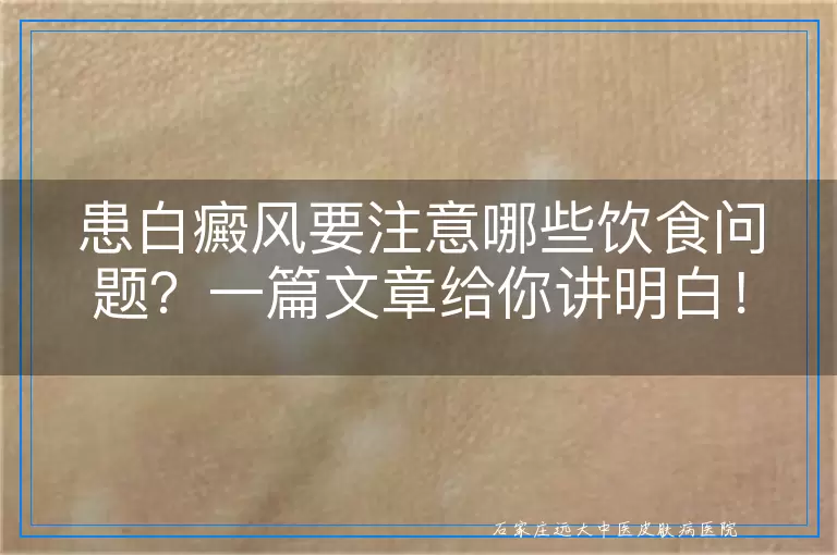 患白癜风要注意哪些饮食问题？一篇文章给你讲明白！