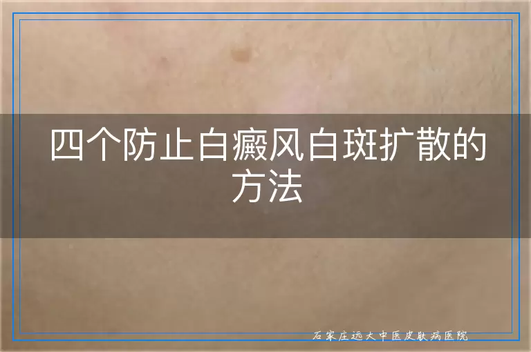 四个防止白癜风白斑扩散的方法