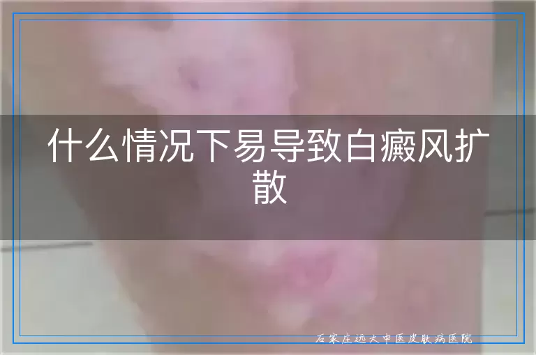 什么情况下易导致白癜风扩散