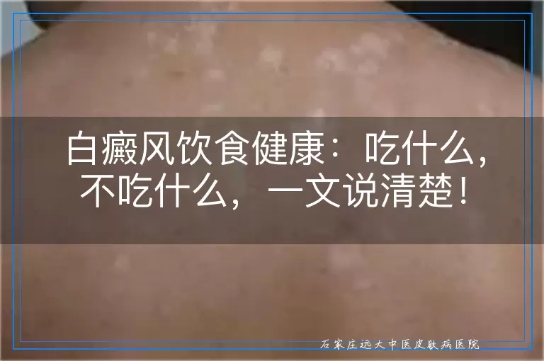 白癜风饮食健康：吃什么，不吃什么，一文说清楚！