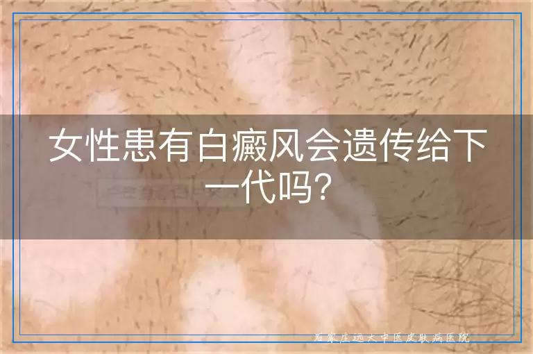 女性患有白癜风会遗传给下一代吗？