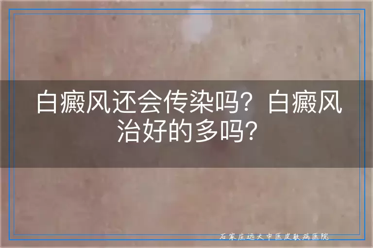 白癜风还会传染吗？白癜风治好的多吗？