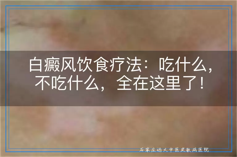白癜风饮食疗法：吃什么，不吃什么，全在这里了！