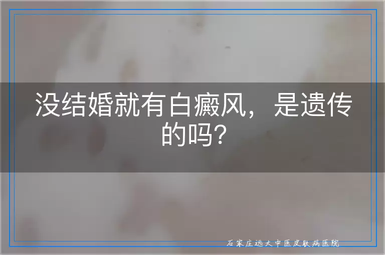 没结婚就有白癜风，是遗传的吗？