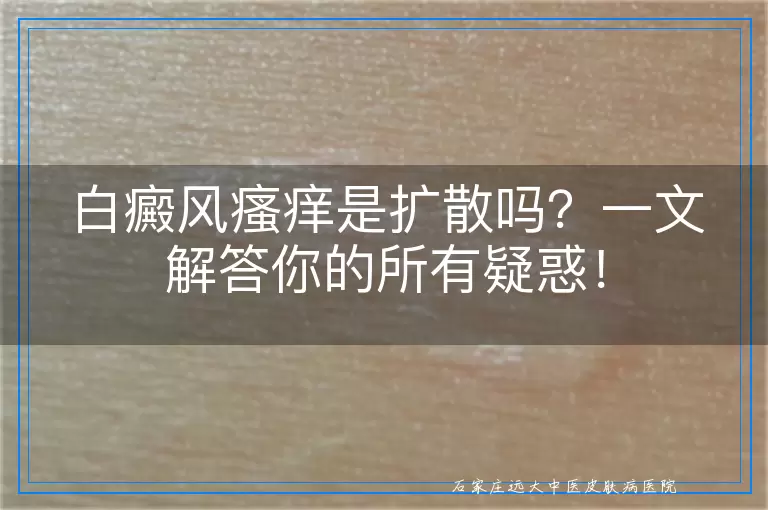 白癜风瘙痒是扩散吗？一文解答你的所有疑惑！