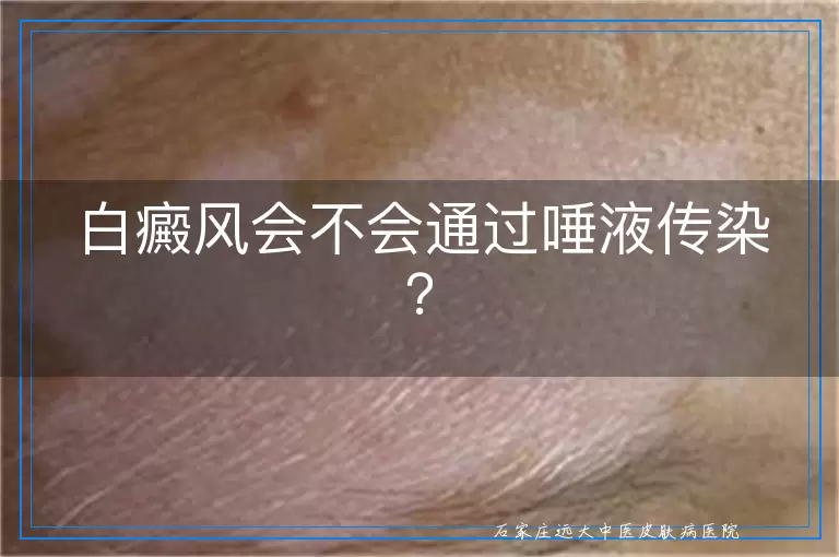 白癜风会不会通过唾液传染？