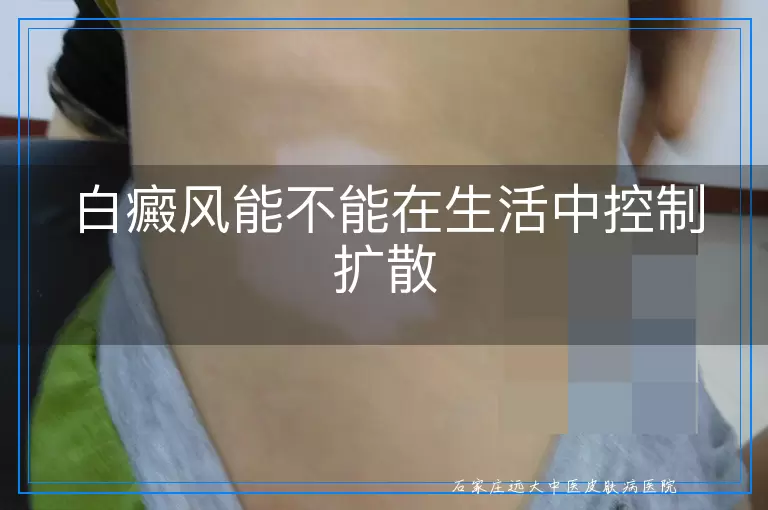 白癜风能不能在生活中控制扩散