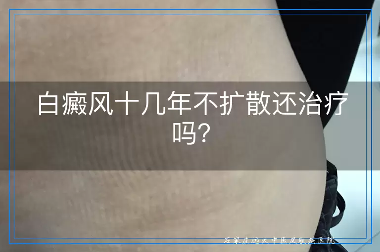 白癜风十几年不扩散还治疗吗？