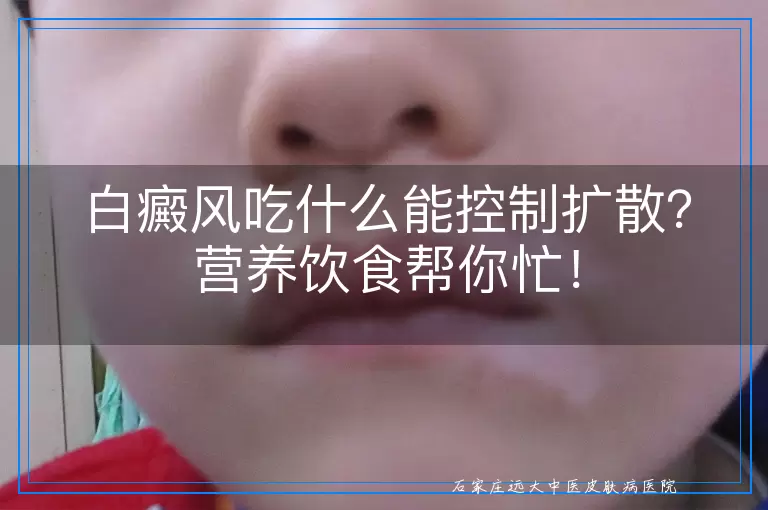 白癜风吃什么能控制扩散？营养饮食帮你忙！