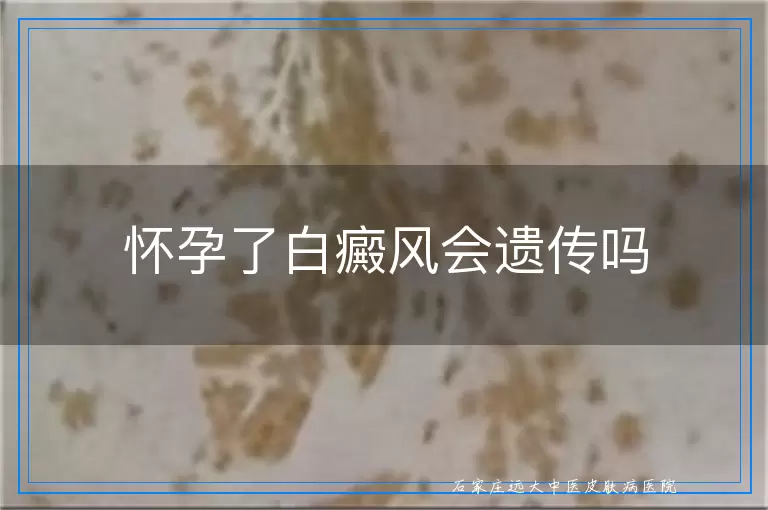 怀孕了白癜风会遗传吗