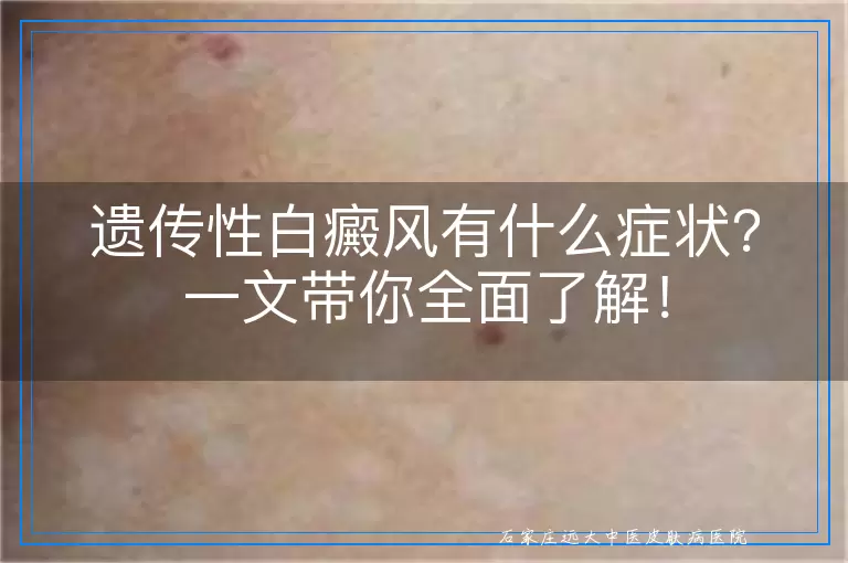 遗传性白癜风有什么症状？一文带你全面了解！