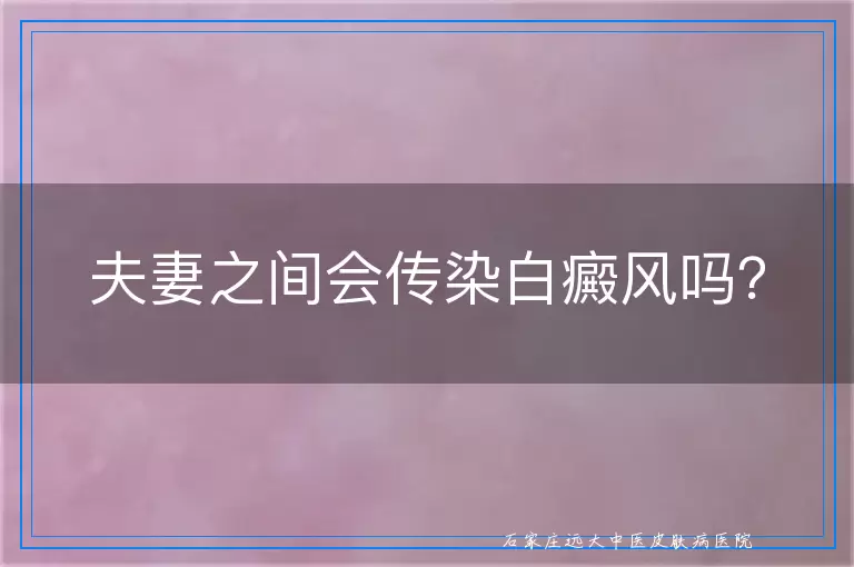 夫妻之间会传染白癜风吗？
