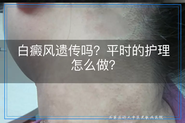 白癜风遗传吗？平时的护理怎么做？