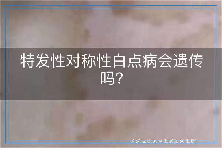 特发性对称性白点病会遗传吗？