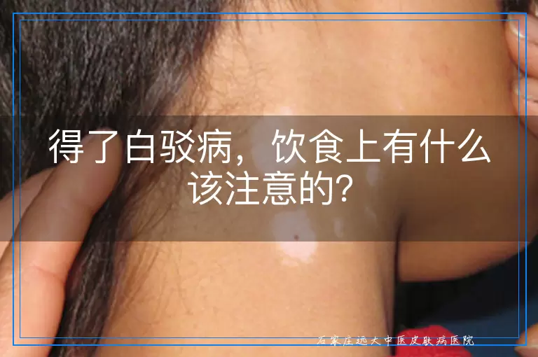 得了白驳病，饮食上有什么该注意的？