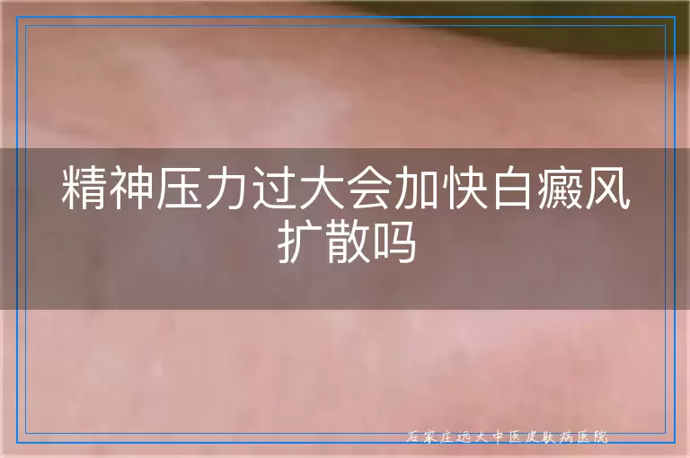 精神压力过大会加快白癜风扩散吗