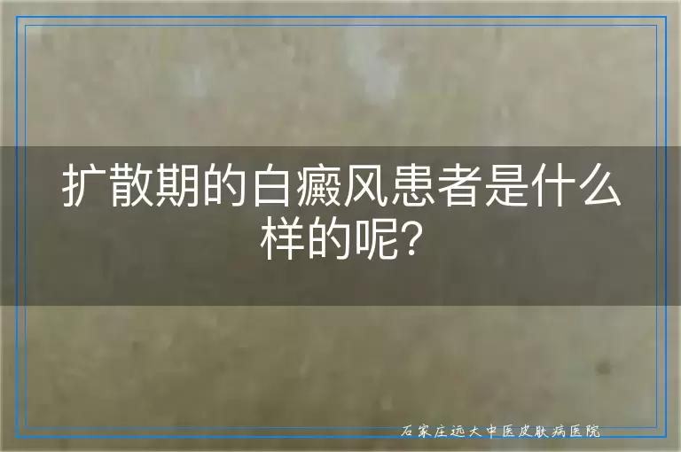 扩散期的白癜风患者是什么样的呢？