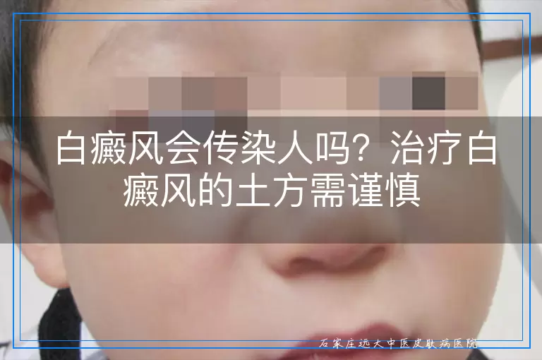 白癜风会传染人吗？治疗白癜风的土方需谨慎