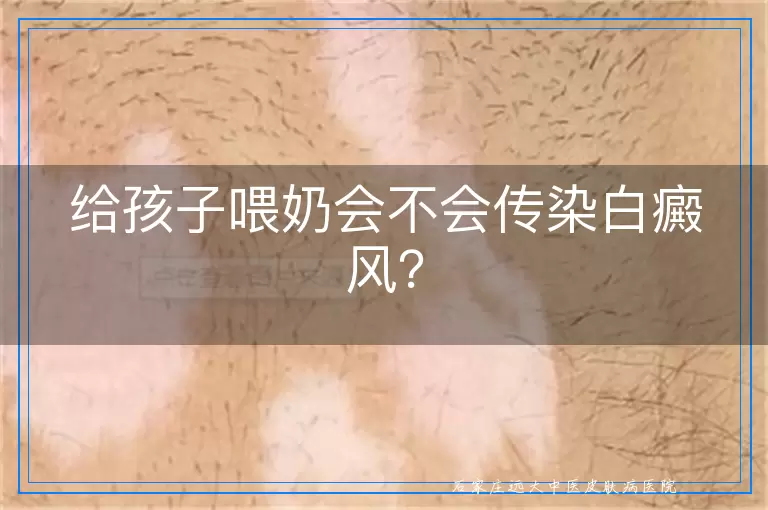 给孩子喂奶会不会传染白癜风？