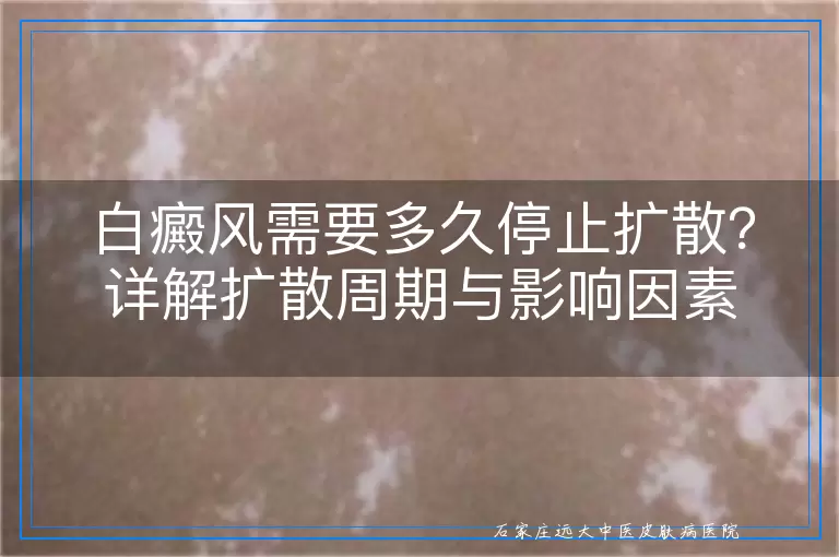 白癜风需要多久停止扩散？详解扩散周期与影响因素