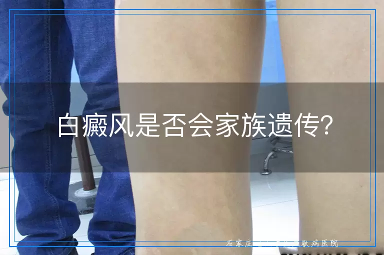 白癜风是否会家族遗传？