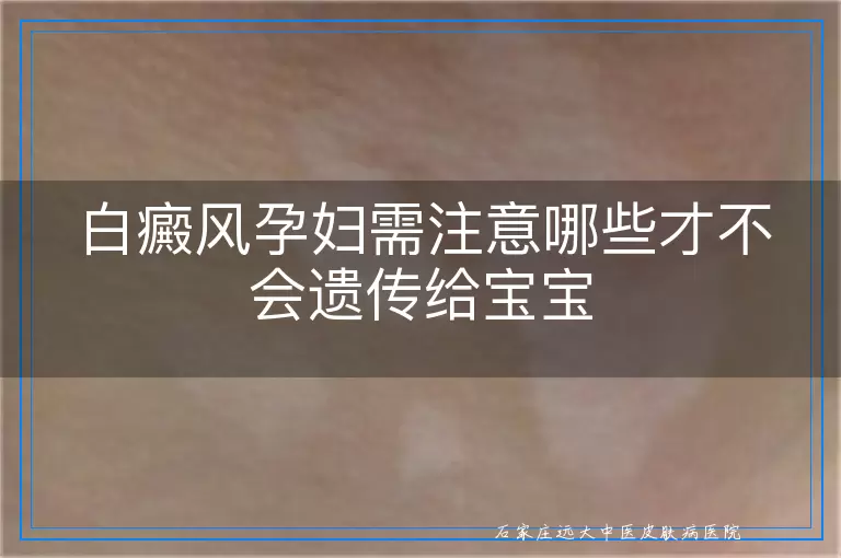 白癜风孕妇需注意哪些才不会遗传给宝宝