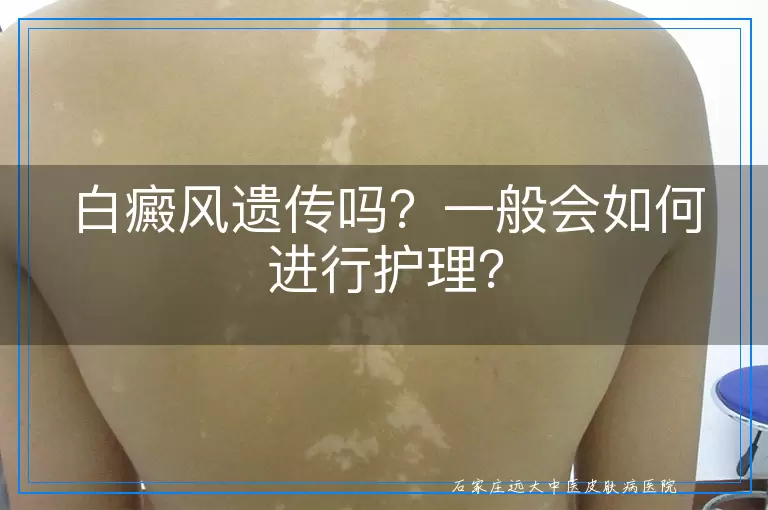白癜风遗传吗？一般会如何进行护理？