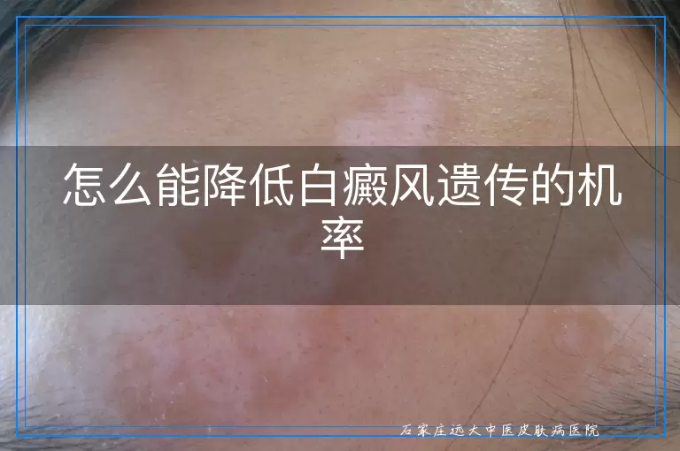 怎么能降低白癜风遗传的机率