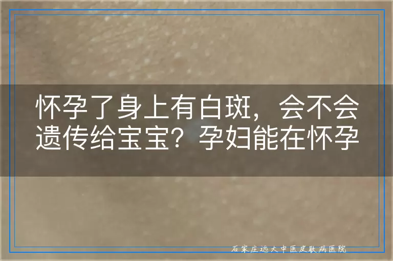 怀孕了身上有白斑，会不会遗传给宝宝？孕妇能在怀孕期间做些什么？