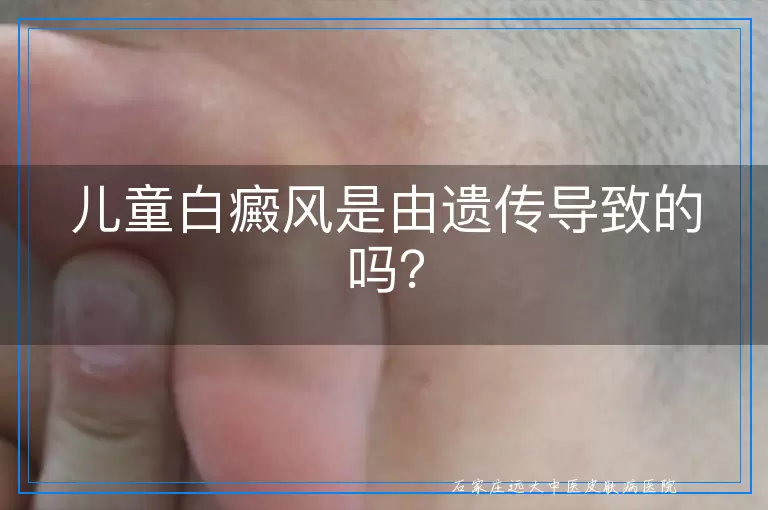 儿童白癜风是由遗传导致的吗？