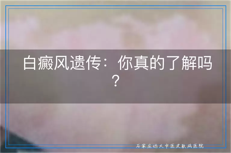 白癜风遗传：你真的了解吗？