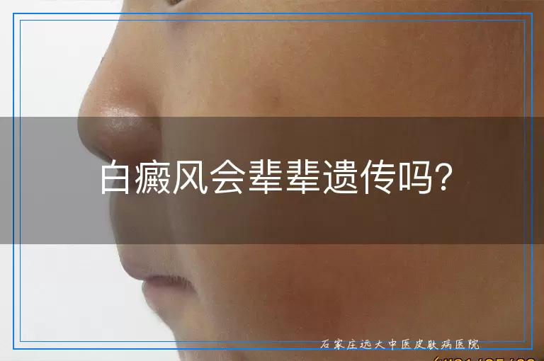 白癜风会辈辈遗传吗？