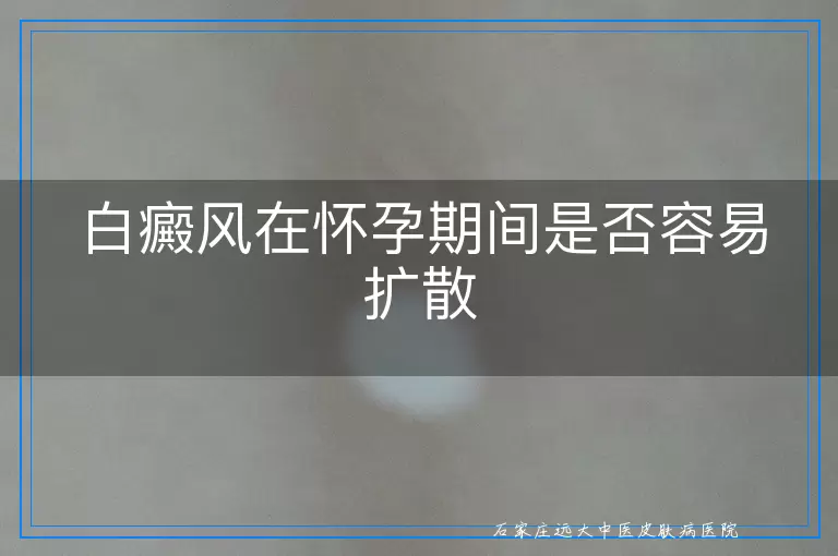 白癜风在怀孕期间是否容易扩散