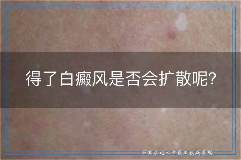 得了白癜风是否会扩散呢？