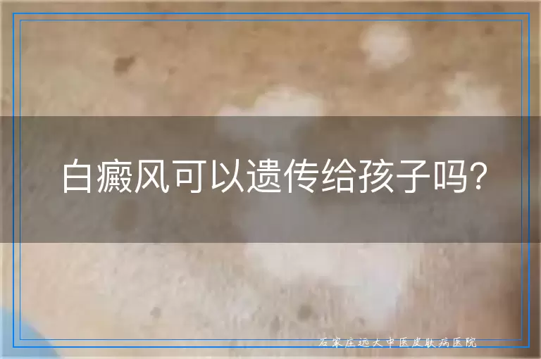 白癜风可以遗传给孩子吗？