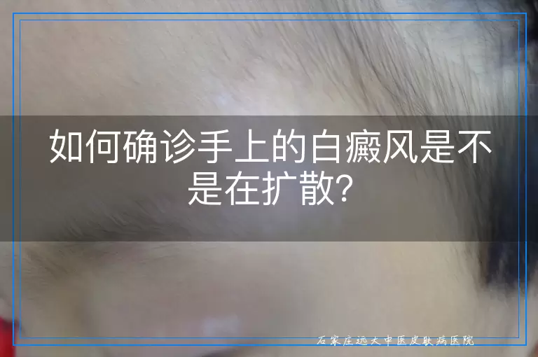 如何确诊手上的白癜风是不是在扩散？