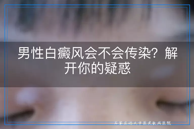 男性白癜风会不会传染？解开你的疑惑