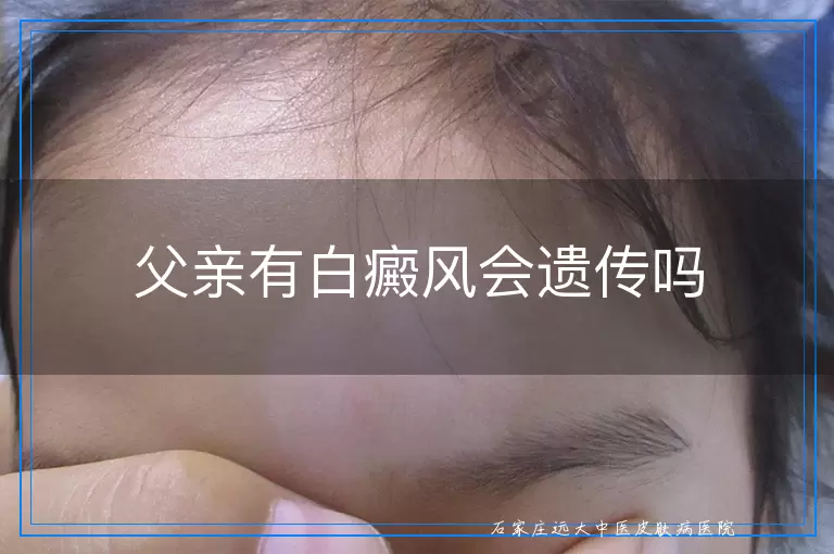 父亲有白癜风会遗传吗