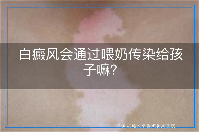 白癜风会通过喂奶传染给孩子嘛？