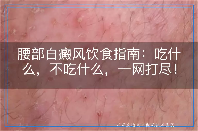 腰部白癜风饮食指南：吃什么，不吃什么，一网打尽！