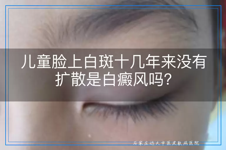 儿童脸上白斑十几年来没有扩散是白癜风吗？