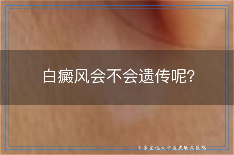 白癜风会不会遗传呢？