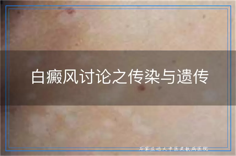 白癜风讨论之传染与遗传