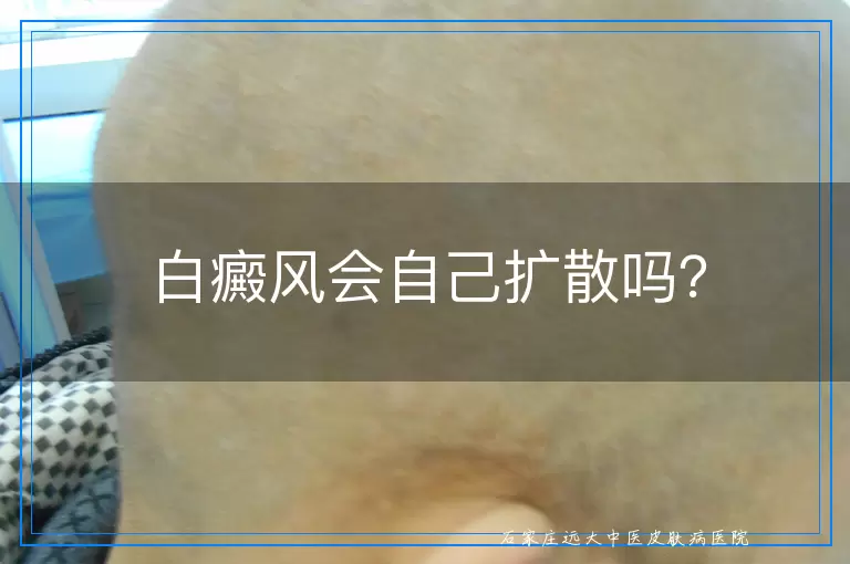 白癜风会自己扩散吗？