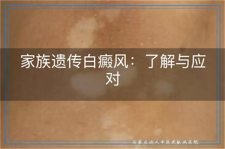 家族遗传白癜风：了解与应对